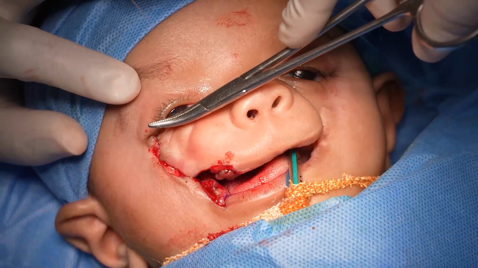 Craniofacial Tessier Facial Cleft Repair